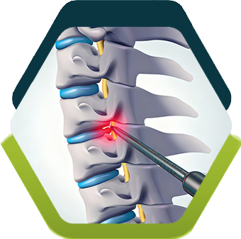 Endoscopia da Coluna